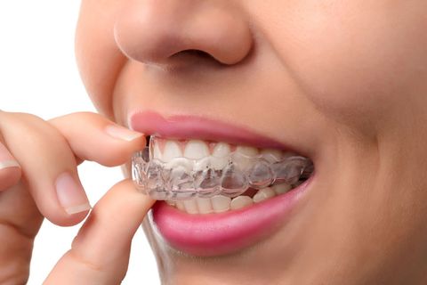 Invisalign Treatment Duration Demystified: Tips and Advice for Planning